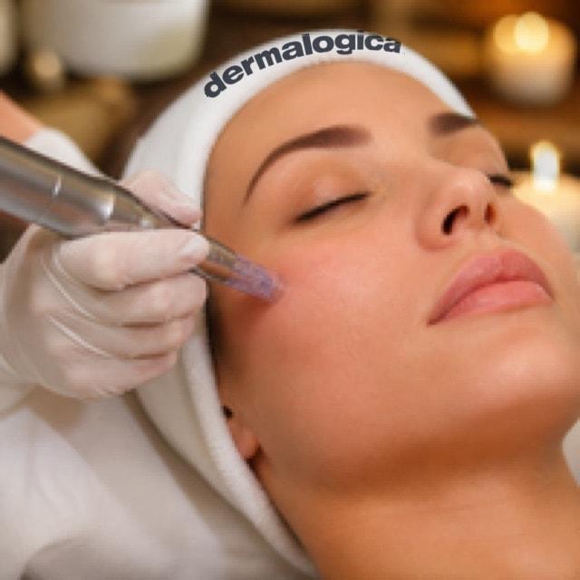 Microneedling treatment at The Skin Ambassador, Athlone